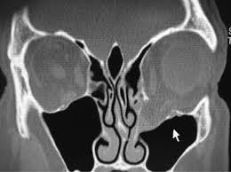 orbital out fracture ento key