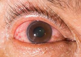 retinal vein occlusion for austin