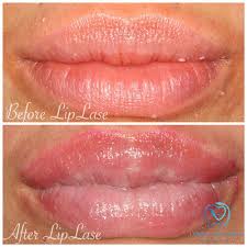 houston laser lip enhancement hieu