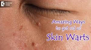 skin warts skin wart removal