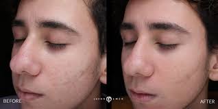 acne scar treatments cosmetic