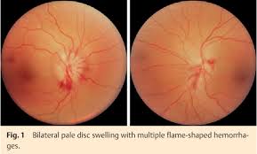 Aion is generally divided into two types: Simultaneous Bilateral Anterior Ischemic Optic Neuropathy Aion In Polycythemia Vera A Case Report Semantic Scholar