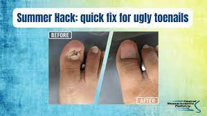 quick fix for ugly toenails