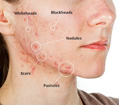 acne treatment the dermatology office