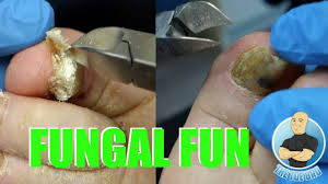 extreme bad nail fungus treatment 1