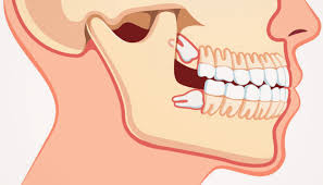impacted wisdom teeth symptoms its
