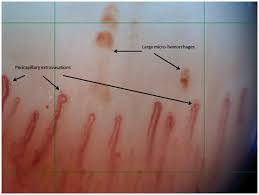nailfold capillary abnormalities in