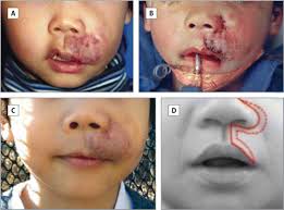 lip infantile hemangiomas