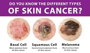 types of skin cancer your great skin