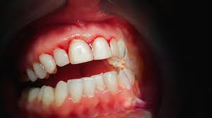 why are my gums bleeding altoona ia