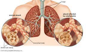 What are the treatments for copd (chronic obstructive pulmonary disease)? Chronic Obstructive Pulmonary Disease Pathology Britannica