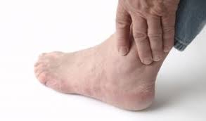 What Is Gout Causes Symptoms And Treatment Live Science