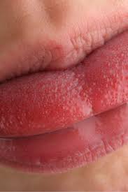swollen taste buds causes diagnosis