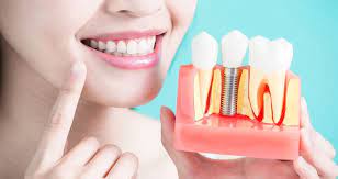 implant dentar cluj napoca oferte