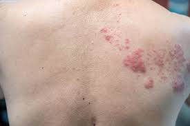 shingles herpes zoster thomson