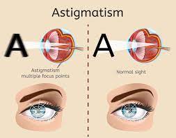 lasik eye surgery cost for astigmatism
