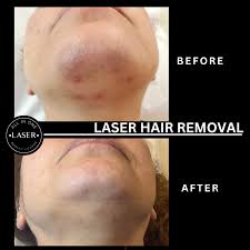 laser hair removal all in one laser