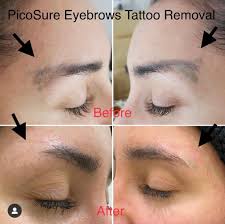 Laser works by repeatedly targeting the ink with pulses of highly concentrated light, which breaks the ink into tiny fragments that are then. Laser Tattoo Removal Sydney Picosure Tattoo Removal Treatment