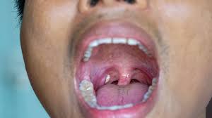 tonsil stones symptoms treatments