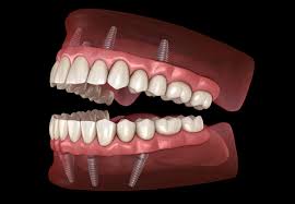 What's worse, many dental insurance plans consider implants cosmetic and won't cover the procedure. All On 4 Dental Implants Procedure And Cost In Houston Tx Voss Dental Oral Surgery Implant