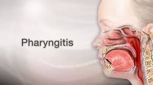 pharyngitis viral information mount