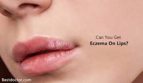 can you get eczema on lips know the