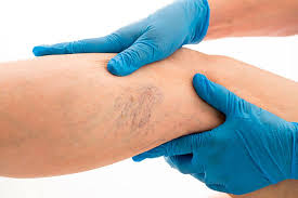 Varicose vein removal with sclerotherapy - CIME Clinic
