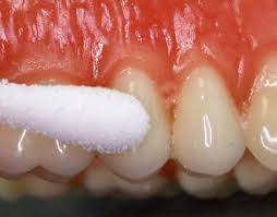 swollen gums treatment fastmed