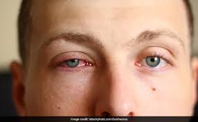 conjunctivitis recovery follow these