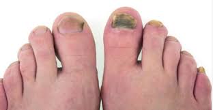 fungal nails arkansas foot ankle
