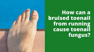 running cause toenail fungus