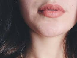 lip licker s dermais causes