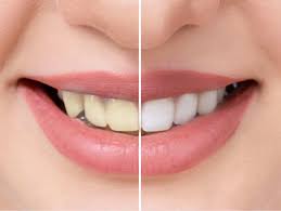 Tea and coffee stains on your teeth occur over time. How To Whiten Your Teeth With Common Kitchen Ingredients The Times Of India