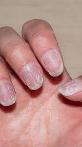 white spots on your nails indicate