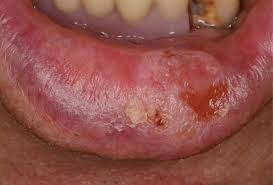 symptoms of lip cancer in patients
