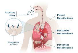 Financial compensation for mesothelioma may come from asbestos trust . Mesothelioma Com ÙÙŠØ³Ø¨ÙˆÙƒ