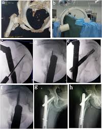 fem intertrochanteric fractures