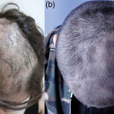 adalimumab induced scalp psoriasis