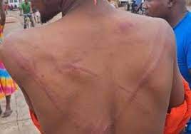 Whip marks inflicted on the back of a civilian during the military raid in Ashaiman