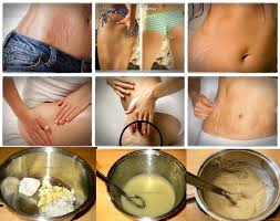homemade creams for old stretch marks