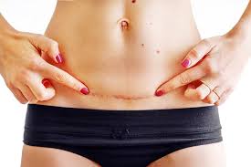 things to know about tummy tuck surgery