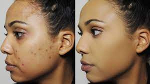 how i cover dark spots acne scars