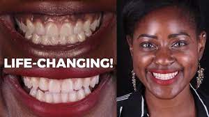 how i turned my black gums to pink