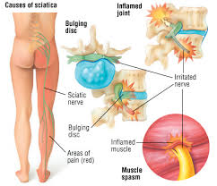 Muscular pain that comes on suddenly in your lower back is often indicative of a muscle spasm. Sciatica Harvard Health