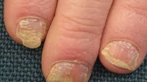 nail psoriasis pictures symptoms and