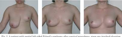 Chest involvement in moderate form of poland's syndrome. Figure 2 From Surgical Treatment Of Patients With Poland S Syndrome Own Experience Semantic Scholar