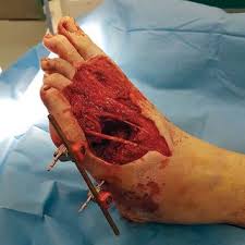If the gunshot wound is straight 90 degrees to the skin, the abrasion will be even all the way around the hole. Pdf Don T Shoot Yourself In The Foot Reconstruction Of A Through And Through Gunshot Wound Of The Foot