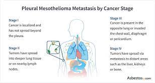 mesothelioma metastasis i factors
