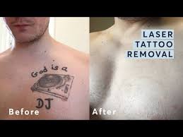 laser tattoo removal in west london