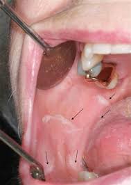 mucosal ling british dental